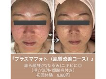 エステティックサロン さらの雰囲気（肌荒れ/赤み/毛穴/ニキビケアには肌質改善プラズマフォトが◎）