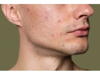 ムム(mumu)の写真/【メンズ大歓迎★】お肌のお悩み、特に毛穴やニキビケアが気になる男性必見!憧れのハリのある素肌へ♪