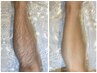 ◆【すね毛スッキリ脱毛】短パンが似合う！(ひざ下表裏甲指含)16500→8250