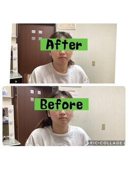 ソラ(SORA)/見事な小顔矯正