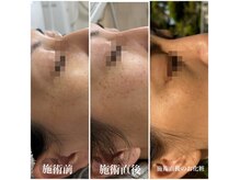 セメヴェール(Saimervell)の雰囲気（詐術前→施術直後→施術後のお化粧後）