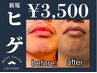 【ご新規様限定★】ヒゲ脱毛￥3500 #メンズ脱毛