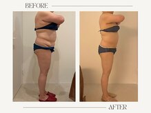 シーアンル(C.aneL)/施術ビフォーアフター　40回