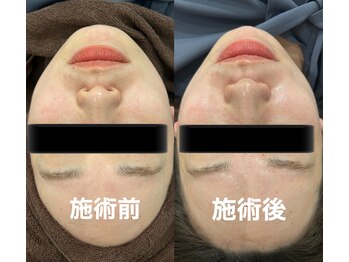 ツール(TOOL)/ハーブピーリング