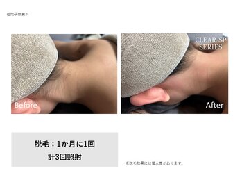 フェレザ 新潟(Felleza)/太い毛も抜ける高出力脱毛