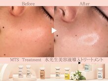 ミモア(mimoi.)の雰囲気（韓国肌管理！艶肌爆誕♪剥離なしのピーリングと生美容液導入）