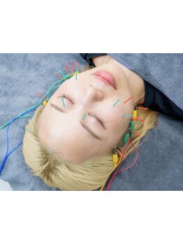 鍼灸施術を受けたい