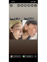 徳島美容サロン/ダクトピール、エクソソーム