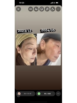 徳島美容サロン/ダクトピール、エクソソーム