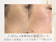 アネラボーテ(Anela Beaute)/韓国女優肌コース艶玉GET