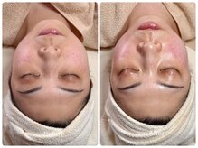 コア(Coeur)/【艶肌爆誕】lamination peeling