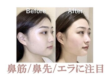 ラプリ 銀座店(Raplit)/隆鼻＋輪郭矯正40分10回