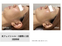 イル 名取店(iru)/光フェイシャル
