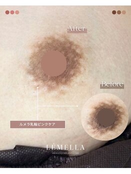エルビービュティーサロン(LB BEAUTY SALON)/【ルメラ乳輪】実績数関西1★
