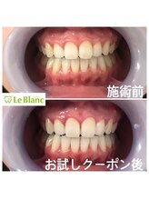 ルブラン 奈良店(Le Blanc)/当店のホワイトニングは凄い！！