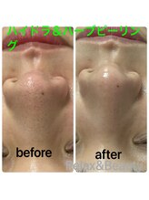 リラックスアンドビューティ(Relax&Beauty)/ハイドラ＆ハーブピーリング