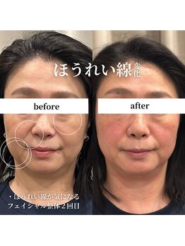 フェアリーフェイス 南森町店(Fairy Face)/南森町/小顔矯正のみ２回目