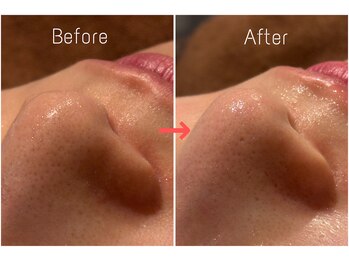 オアシスサカエ(OASIS SAKAE)/【水素毛穴洗浄】