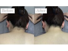 ビオラス 光吉店(VIOLUS)/うなじ＋背中脱毛