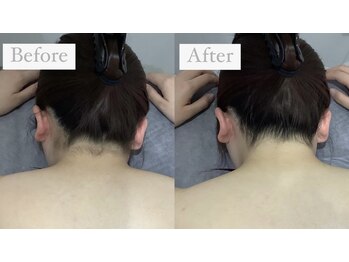 ビオラス 光吉店(VIOLUS)/うなじ＋背中脱毛