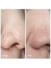 スキンラボ カホクカイ(KaHokuKai)/１回/4週　　３回目