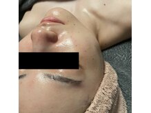 【韓国発ララピール】ダウンタイムなしで毛穴レス水光ツヤ肌