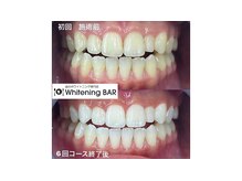 ホワイトニングバー 心斎橋オーパ店/年間8万人が選ぶ理由