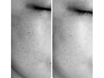 オリエンス(oriens)/ハーブピーリング2回