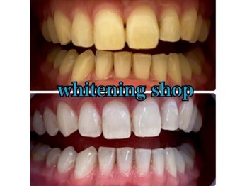 ホワイトニングショップ 武蔵小杉店/【BeforeAfter】10回 施術後比較