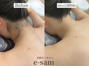 イーサム(e-sam)/丸ごと全身脱毛