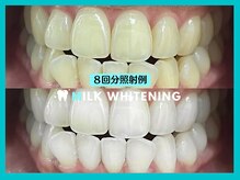 ミルクホワイトニング 長崎中央橋店(Milkホワイトニング)/◆施術例