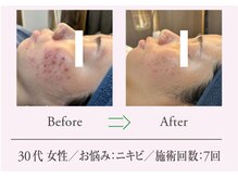 エステプロ ラボ 自由が丘/Before→After