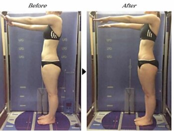 ビューティークリニックコダマ 宮崎本店/【2か月コース】M.H様（21歳）