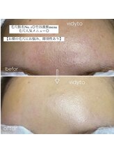 ヴィディトゥ(vidyto)/人気毛穴改善コース＋エンビロン
