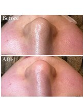 マドモアゼル 麻布十番/毛穴洗浄