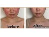 20代に人気♪お顔の横幅・ボリュームダウン【小顔矯正＋上半身リンパ★90分】