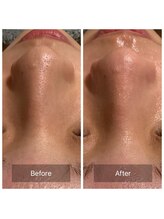 エヌ(enu)/毛穴黒ずみ/毛穴洗浄