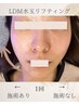 6月限定【小顔×韓国肌】毛穴洗浄＋LDM小顔リフト　通常18700→