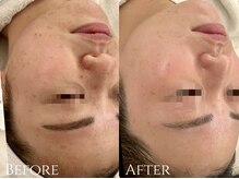 サロンブランシュ(salon BLANCHE)/CHRISTINA【ニキビケア】