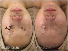 ソフ(soph.)/ニキビ改善