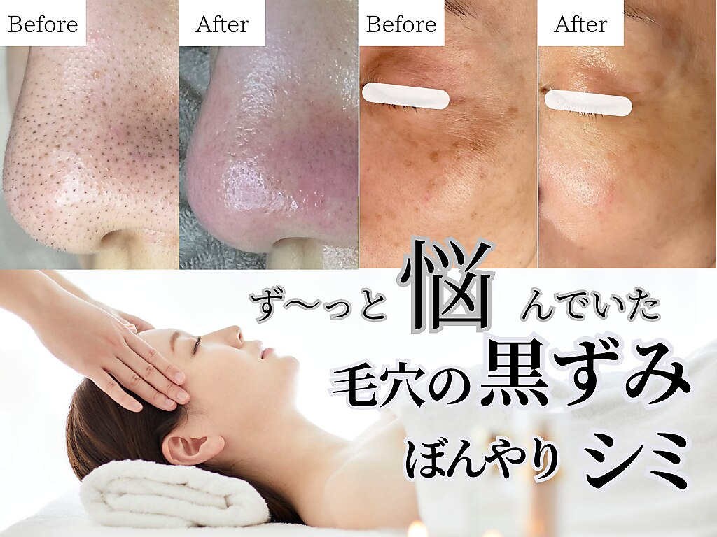 名古屋市昭和区で毛穴洗浄・毛穴吸引が人気のエステサロン