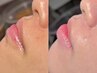 【秋のオススメ】美肌ポレーション+ワックス美顔脱毛Sパーツ 17600→14300