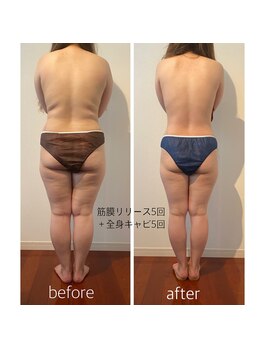 バンブー(bamboo)/筋膜リリース5回+全身キャビ5回