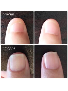 自爪ケア専門サロン イニュラ(inula)/爪育成の劇的変化！