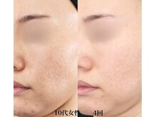 ブレア(Blair)/マイクロニードル×ピンクグロウ