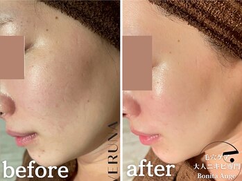 ボニータアンジュ 恵比寿(Bonita Ange)/渋谷ハーブピーリング｜症例