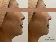 リボーン 柏(REBORN)/下半顔すっきりフェイスケア
