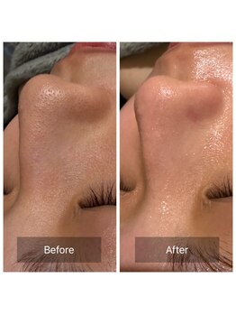 エヌ(enu)/毛穴黒ずみ/毛穴洗浄