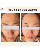 イロドリ(IRODORI)/REVIハーブピーリング