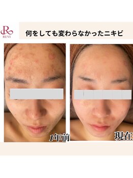 イロドリ(IRODORI)/REVIハーブピーリング